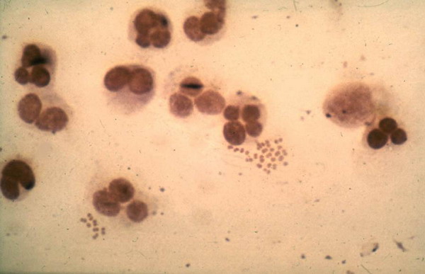 File:Neisseria menigitidis leukocyt spinal gram.jpg